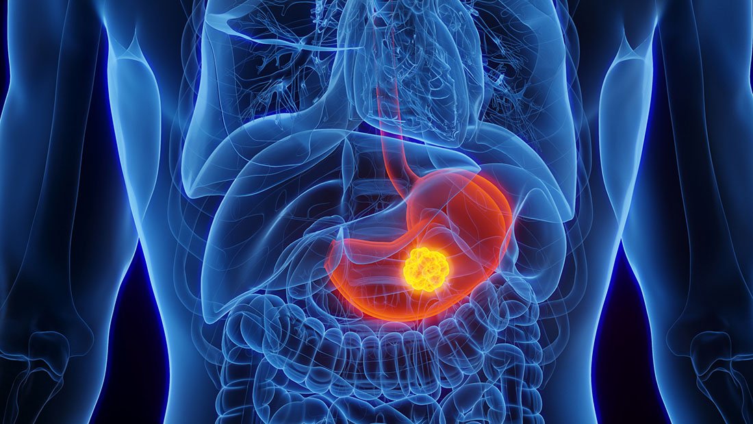 img-gastric-cancer-illustration
